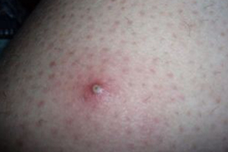 毛囊炎大腿起疙瘩图