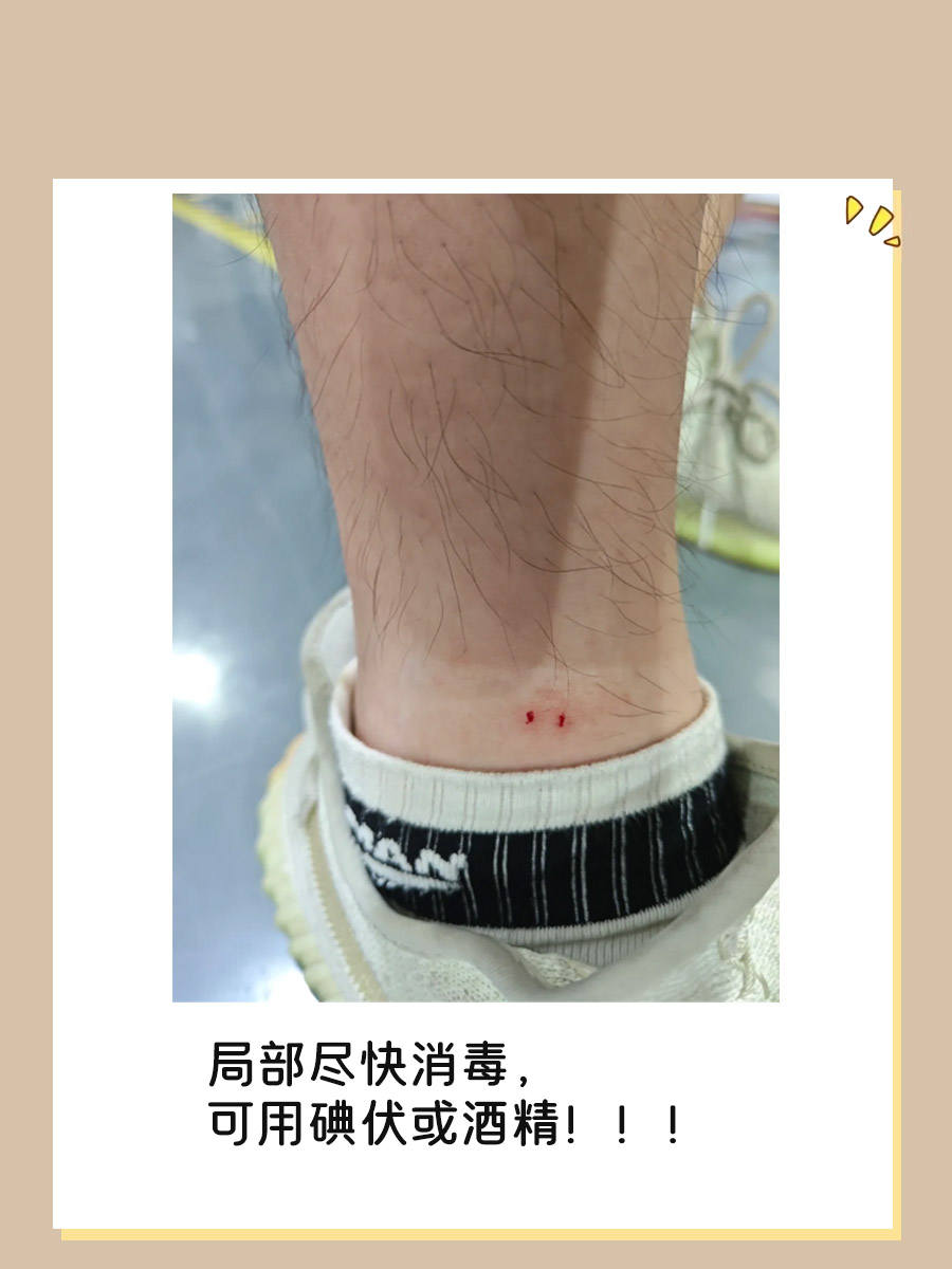 无毒蛇咬了人会怎么样？该怎么办？