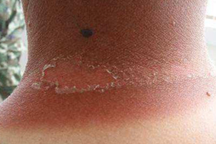 日光性皮炎后颈脱皮图