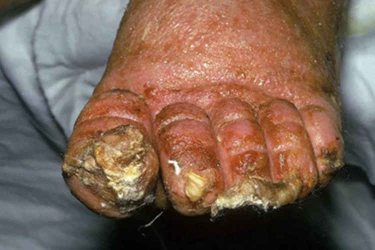 蜂窝织炎脚趾糜烂图