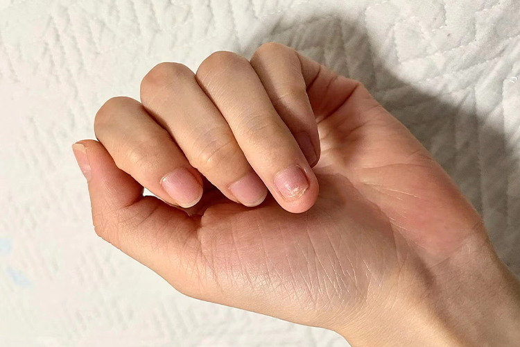 手指拔甲后长出图