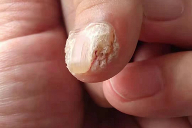 寻常疣手指甲变形图