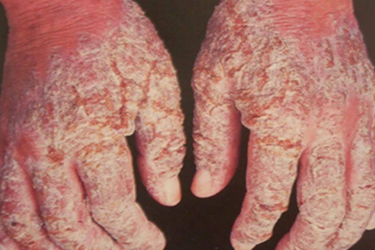 变应性接触性皮炎裂口图