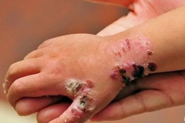 获得性大疱性表皮松解症结痂图 获得性大疱性表皮松解症结痂图