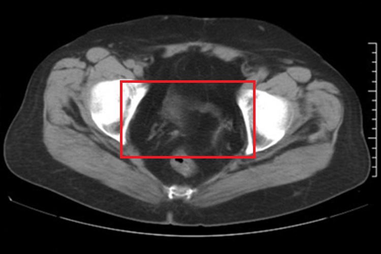 子宫切除恢复后影像图 子宫切除恢复后影像图