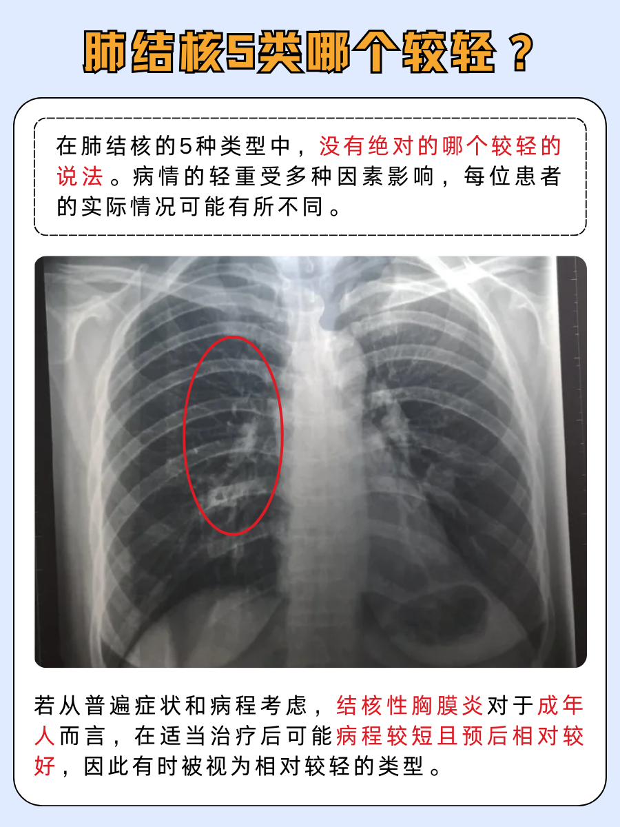 肺结核5类大盘点，哪种肺结核较轻？