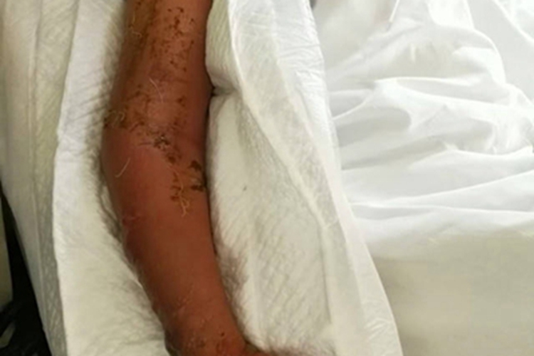 炭疽病胳膊红肿图