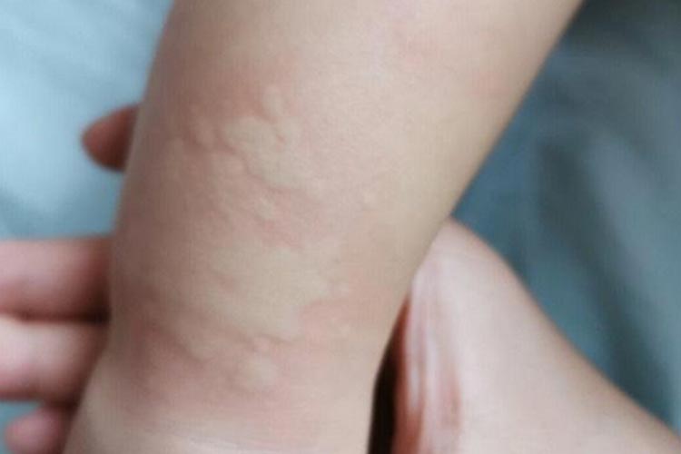 手臂大小不等风团图