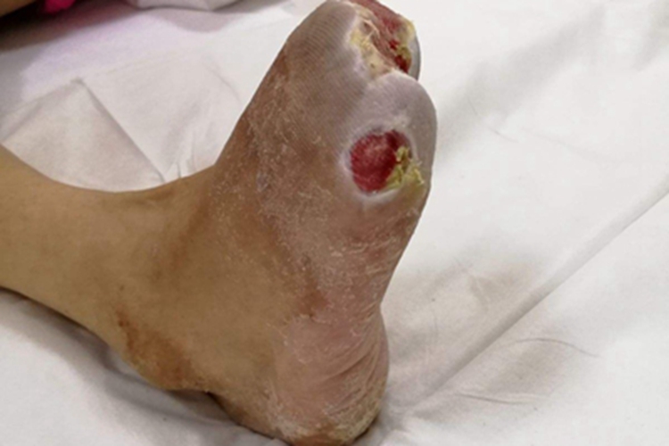 慢性乳头状溃疡性脓皮病黄痂图