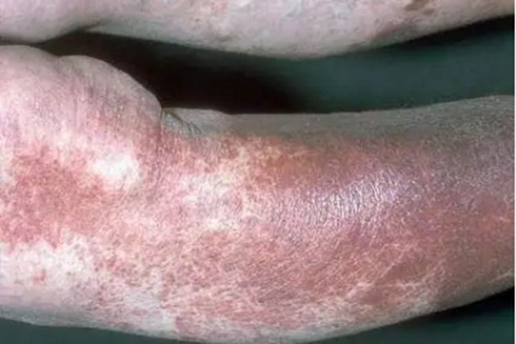 色素性紫癜性苔藓样皮炎斑图 色素性紫癜性苔藓样皮炎斑图