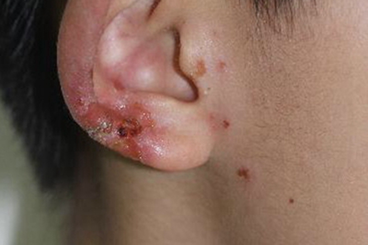 脓窝疮耳廓皮肤结痂图