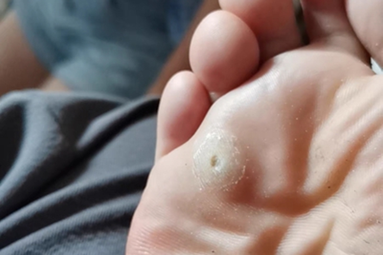 硬鸡眼脚底症状图