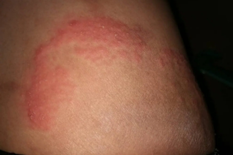 红癣大腿上有红斑起皮图