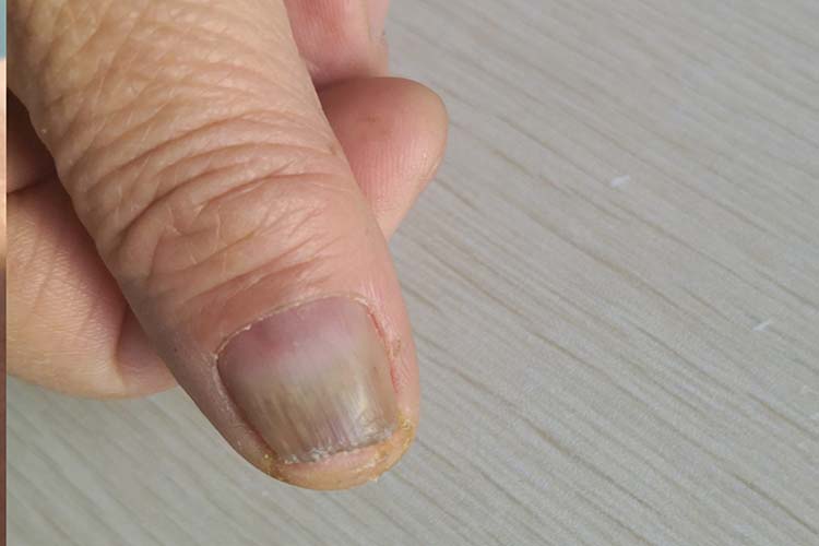 远端侧位甲下型甲癣图