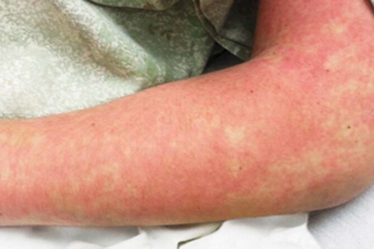 斑疹伤寒胳膊红斑图