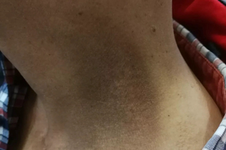 放射性皮炎皮肤发黑图 放射性皮炎皮肤发黑图