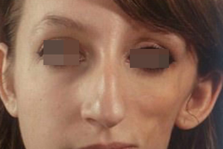 进行性单侧面萎缩面部变形图 进行性单侧面萎缩面部变形图