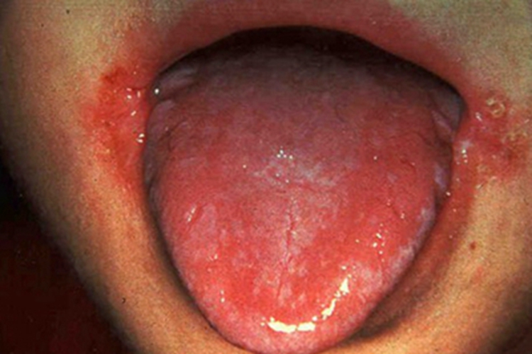 口角炎糜烂图 口角炎糜烂图