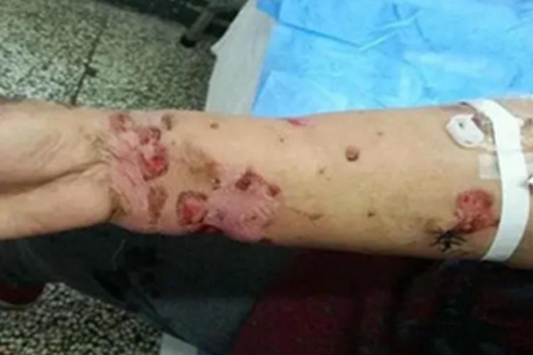 副肿瘤性天疱疮胳膊糜烂图