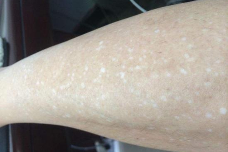 腿上特发性白斑小白点图