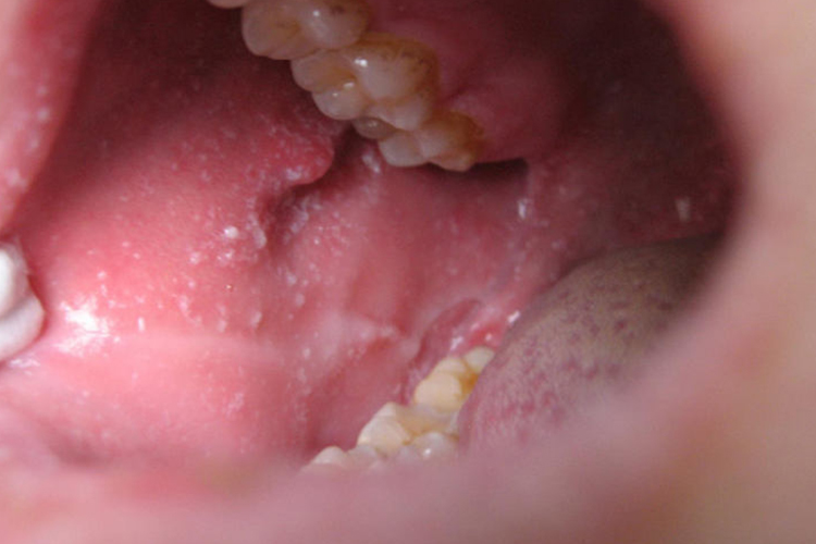 小儿麻疹口腔麻疹黏膜斑图