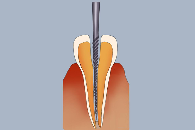 门牙根管治疗的步骤过程图解_有来医生