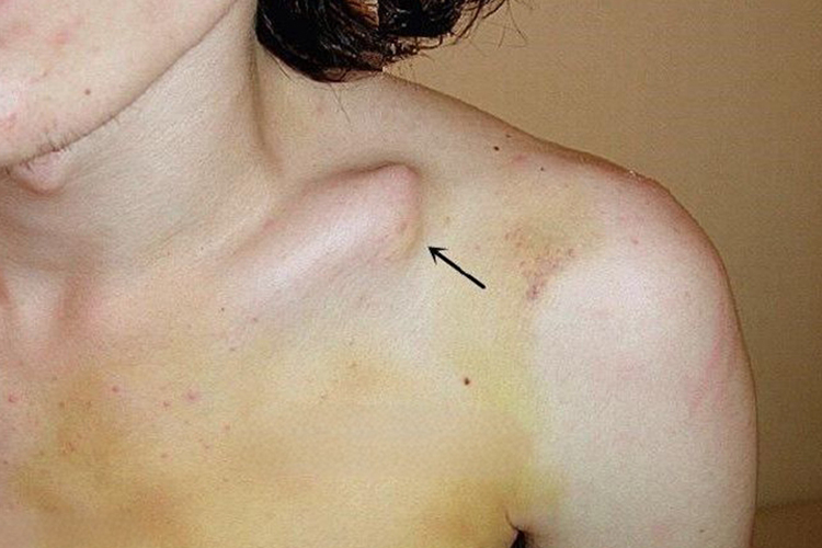 左锁骨骨折症状图 左锁骨骨折症状图