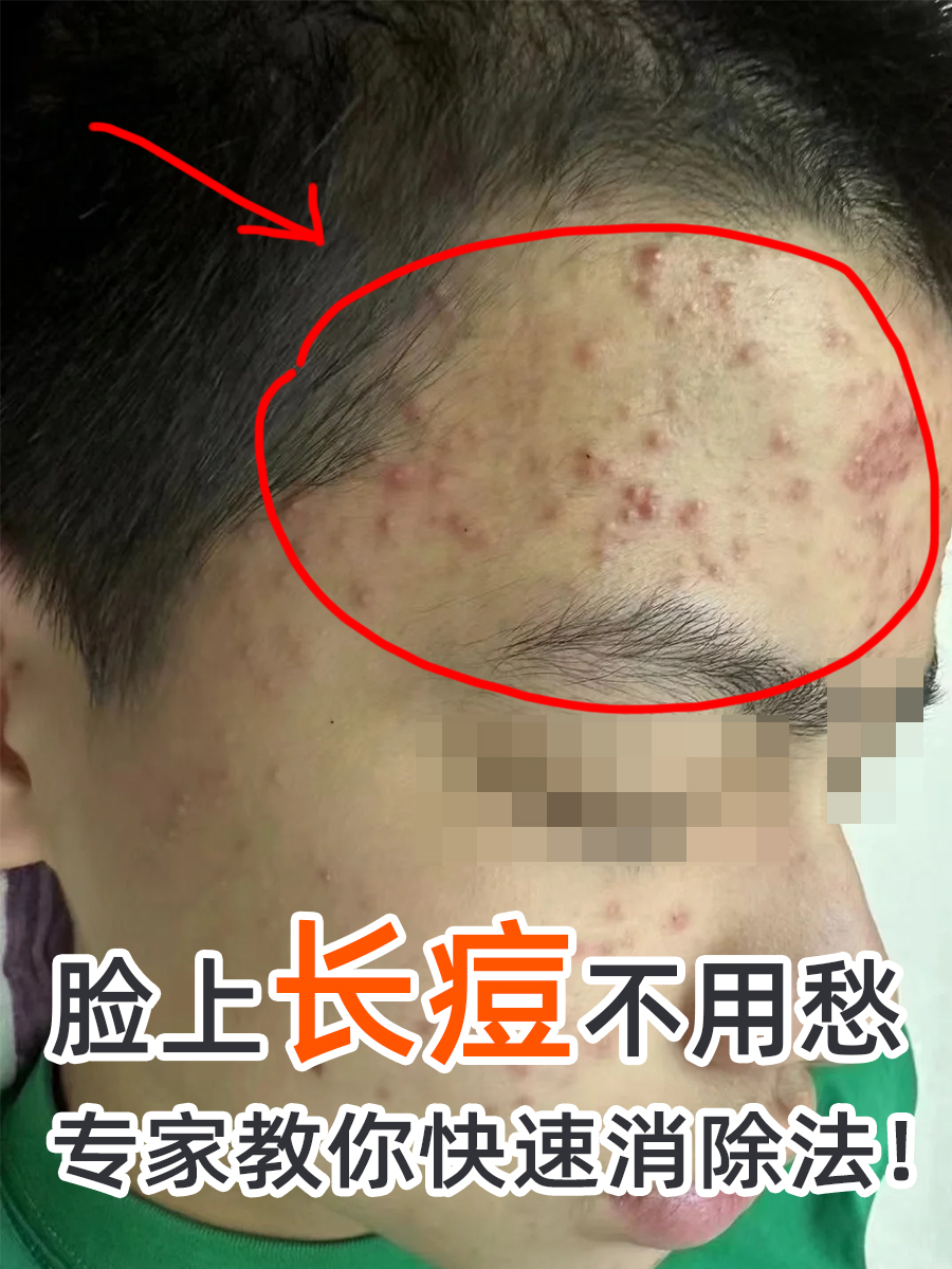 脸上长痘不用愁,专家教你快速消除法!