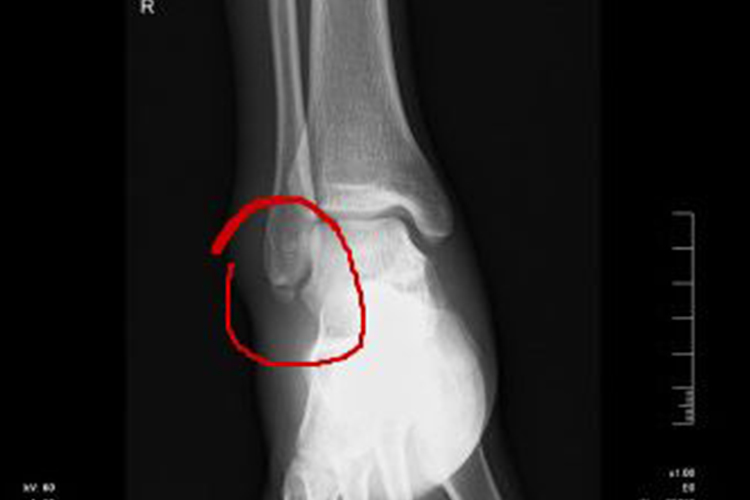 脚踝轻微骨裂图 脚踝轻微骨裂图