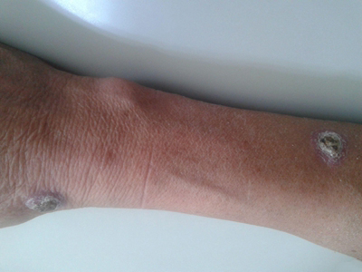 诺卡菌病手臂两处破溃结痂图