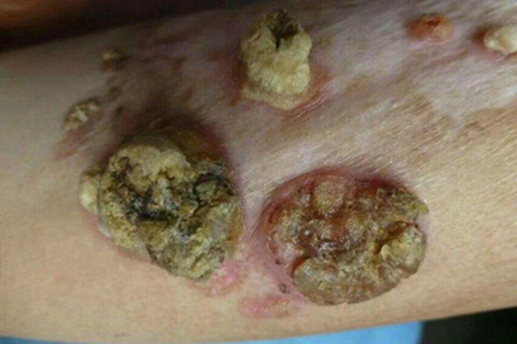 真菌性肉芽肿大疙瘩图 真菌性肉芽肿大疙瘩图