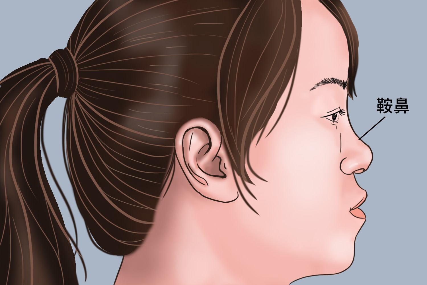 鞍鼻外观图 鞍鼻外观图