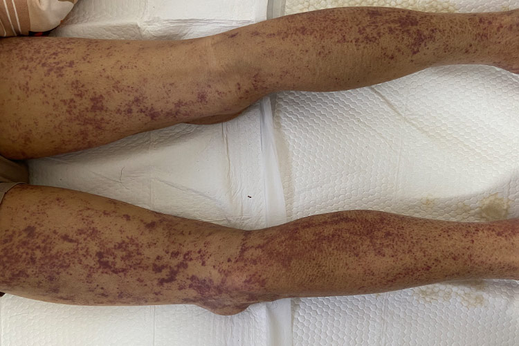 紫癜皮下出血图片_有来医生