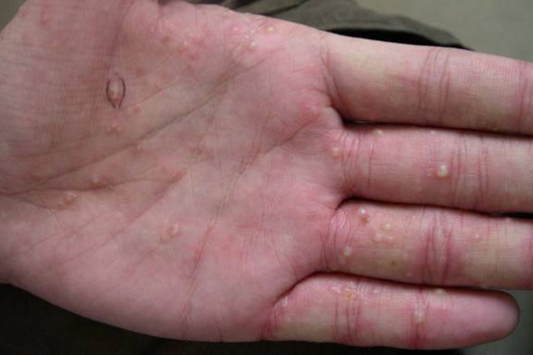 手掌汗疱疹图