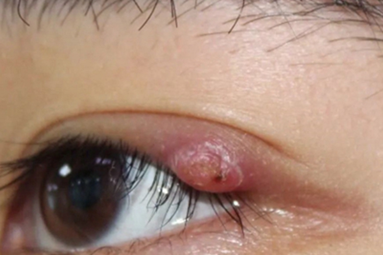 外睑腺炎眼睑疙瘩图
