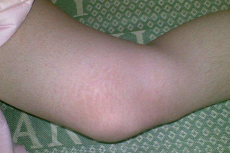 男孩青春期生长纹图