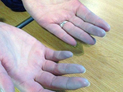 混合性结缔组织病手指皮肤发紫图