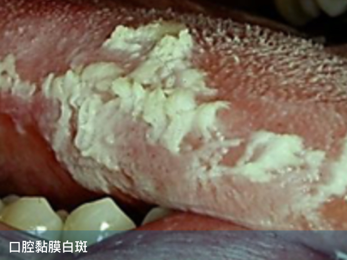 口腔黏膜白斑