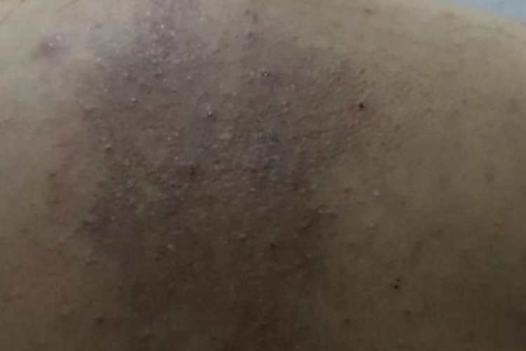 冬季瘙痒症背上有干纹图