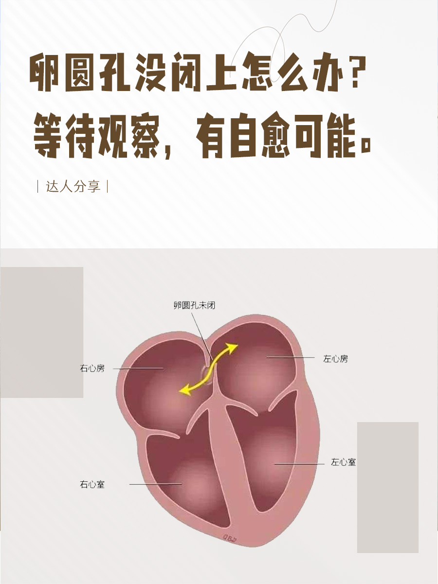 卵圆孔未闭，该如何应对？这篇告诉你