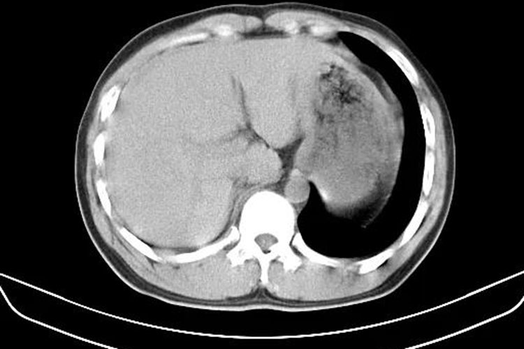 肝破裂出血CT影像表现图 肝破裂出血CT影像表现图