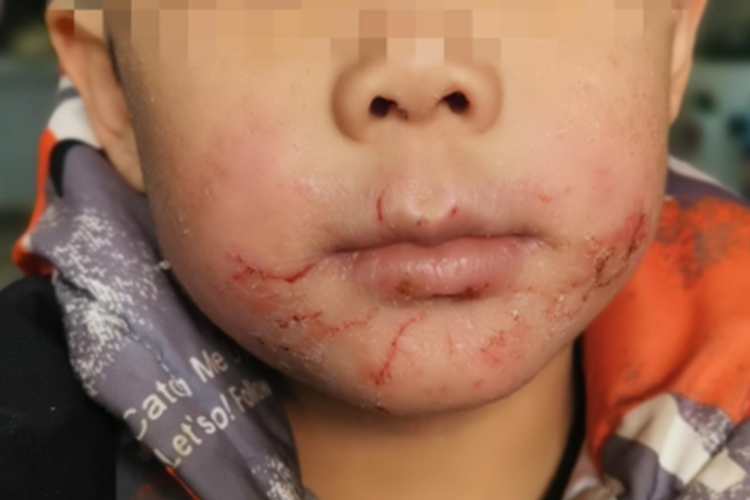 葡萄球菌性烫伤样综合征图