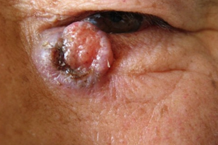 结节型基底细胞癌小疙瘩图 结节型基底细胞癌小疙瘩图