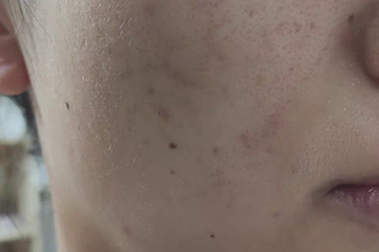 痤疮右脸有褐色斑图