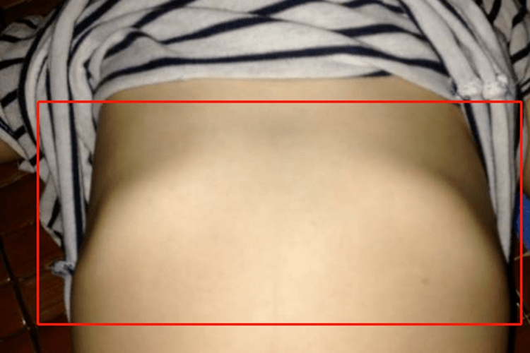 一岁半宝宝肋骨外翻图 一岁半宝宝肋骨外翻图