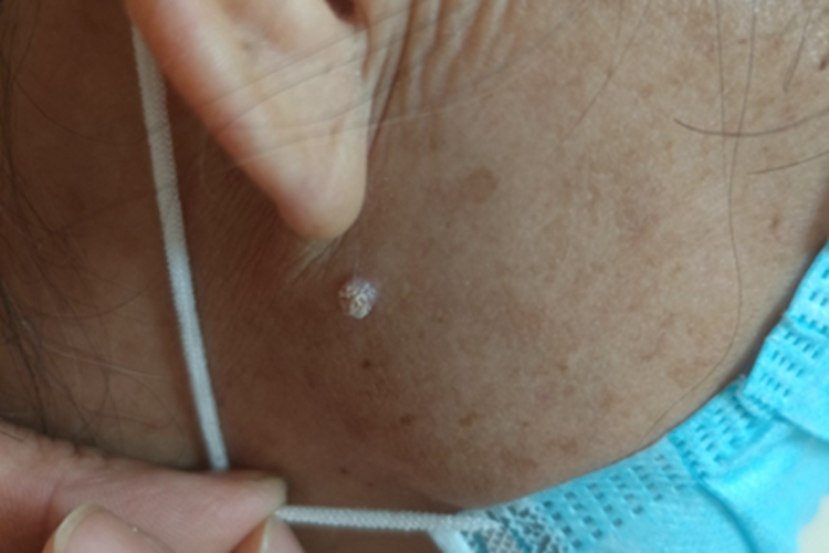 寻常疣右侧面部菜花状丘疹图