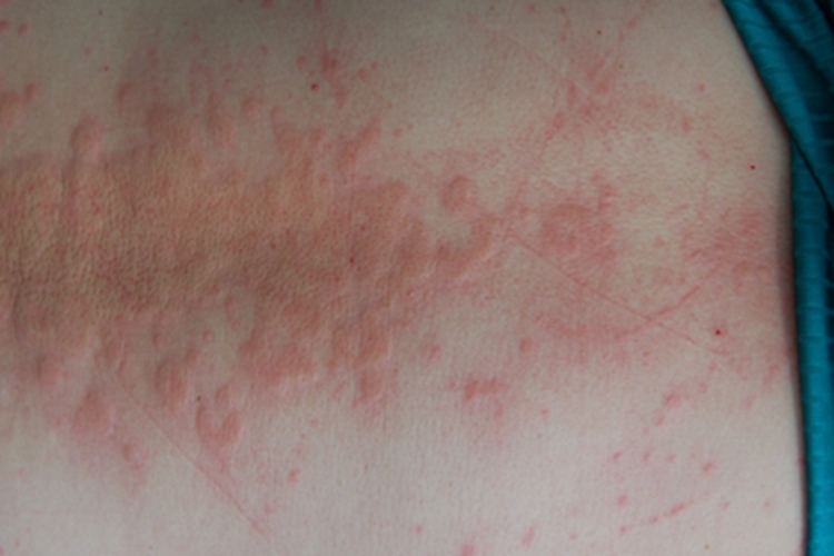 慢性自发性荨麻疹背部疙瘩图 慢性自发性荨麻疹背部疙瘩图