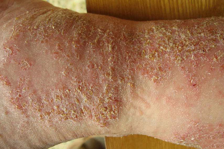 湿疹皮肤有结痂样东西图 湿疹皮肤有结痂样东西图