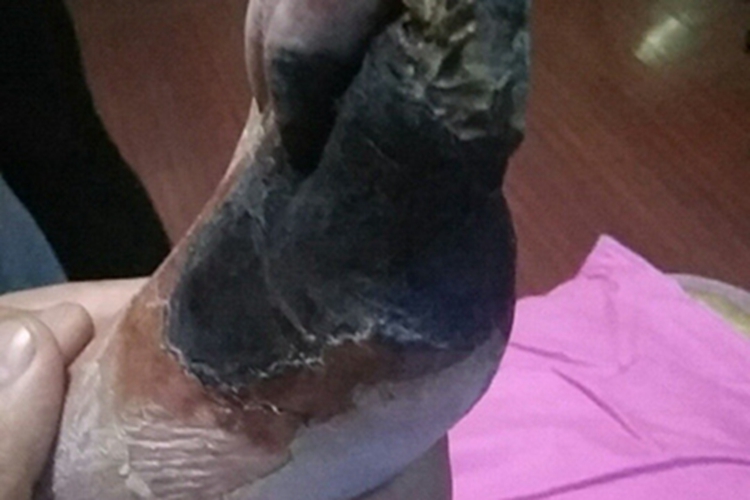 坏疽脱皮图 坏疽脱皮图