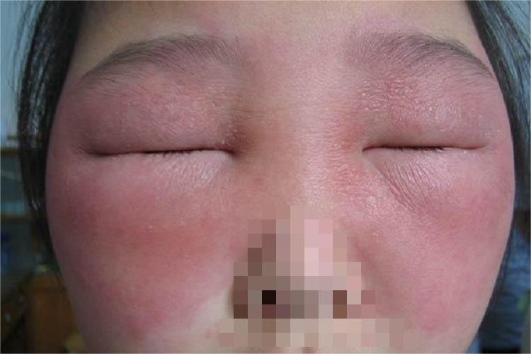 过敏性皮炎眼睑红肿图